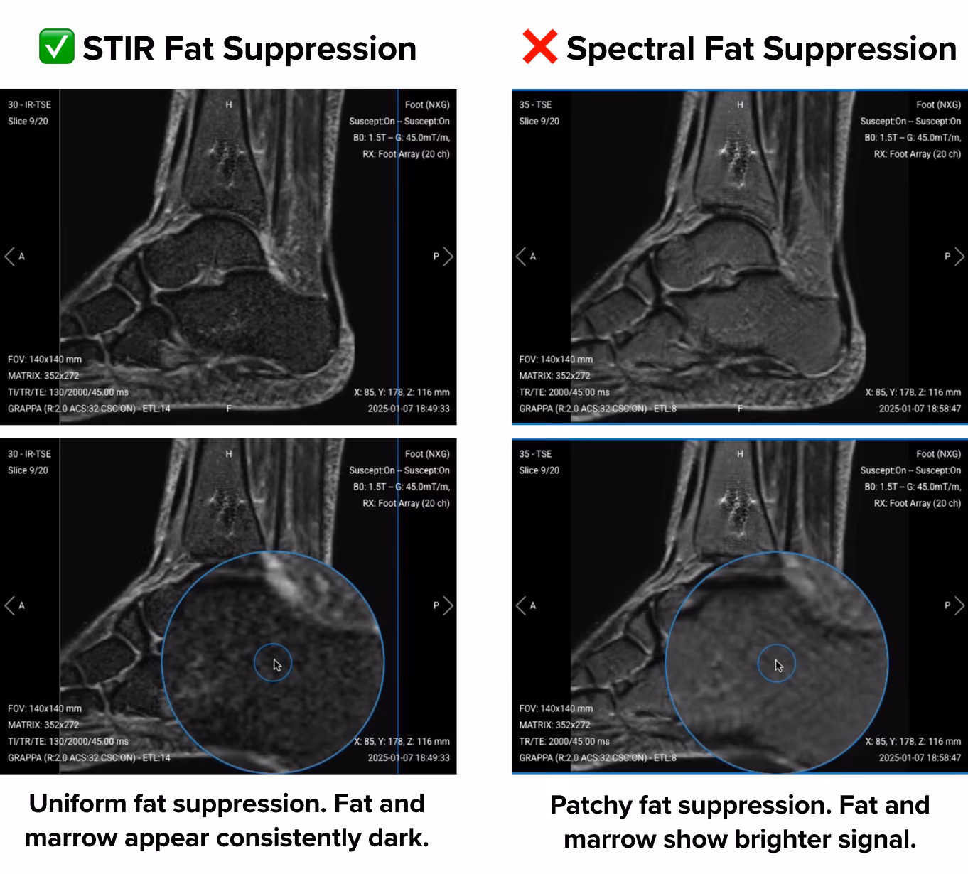 STIR vs spectral fat suppression. To the left, STIR images show uniform fat suppression where fat and marrow appear consistently dark. To the right, spectral images show patchy fat suppression where fat and marrow show brighter signal. 