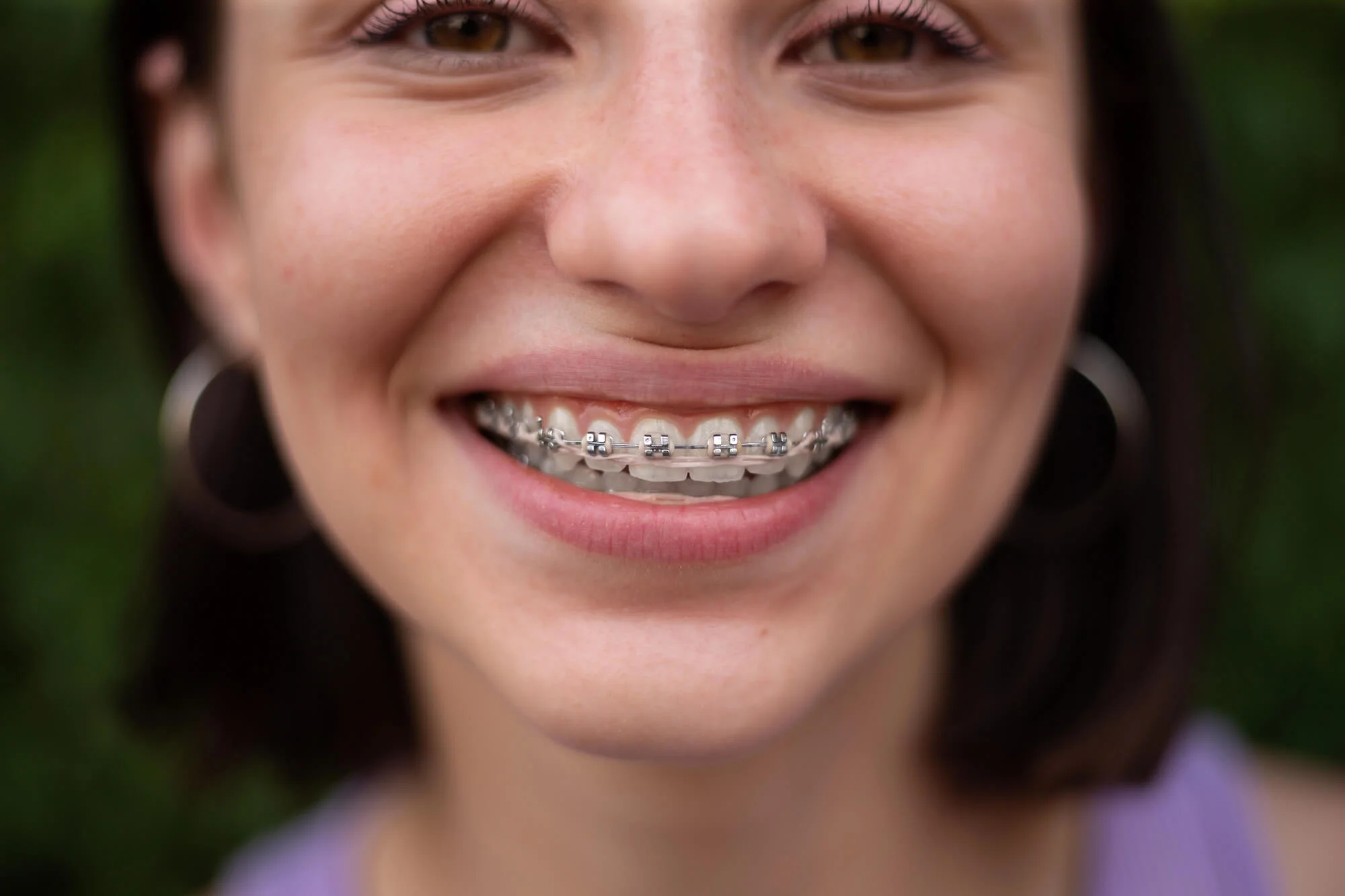 straightening teeth with Braces Near Me