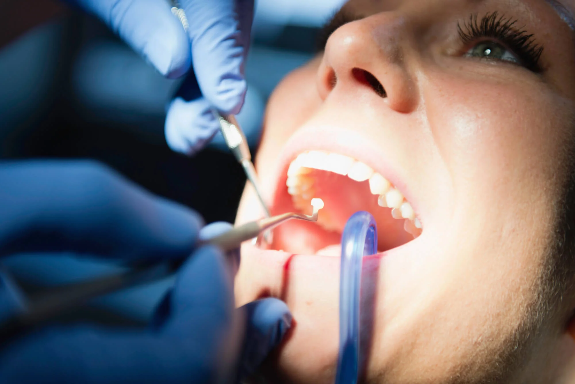 Closeup dental checkup with dentist examining patient teeth – affordable denture