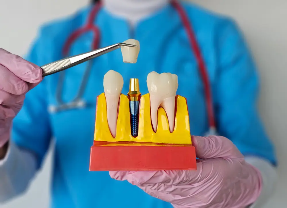 Dental implant model showing a crown, abutment, and implant post