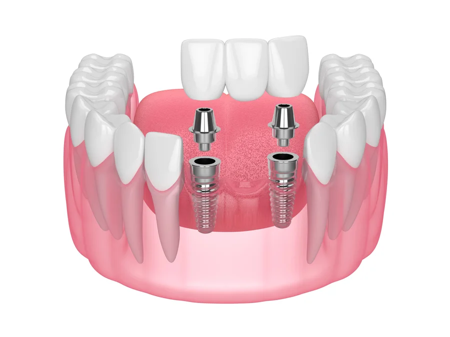 dental-implants-near-me-3d-model-of-two-implants-supporting-front-bridge