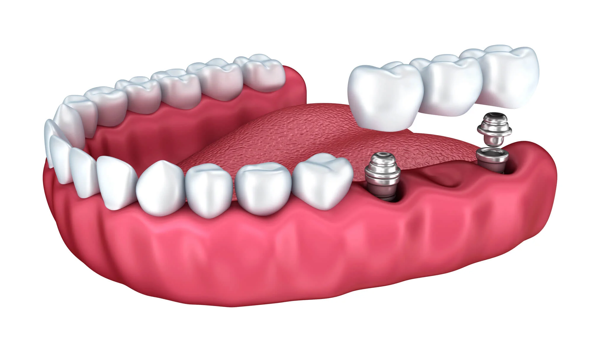3D illustration of dental bridges near me