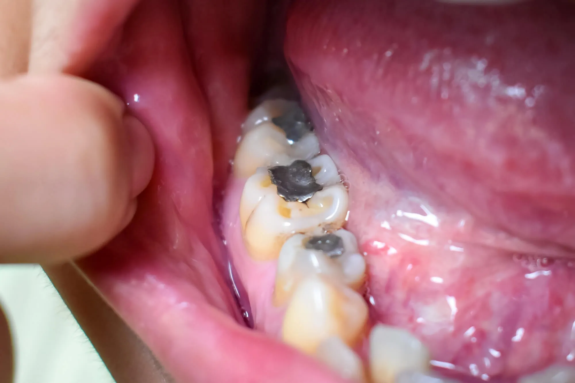 amalgam as dental crown alternative