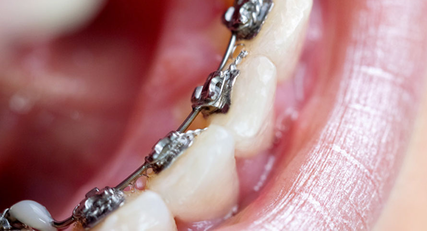 Close up einer Person mit Metallbrackets auch der Innenseite der Zähne.