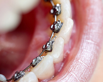 Nahaufnahme von Zähnen mit Metallbrackets, die auf der Innenseite der unteren Zähne befestigt sind.