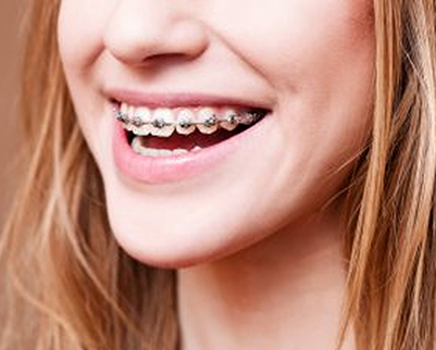 Nahaufnahme einer lächelnden Person mit Zahnspange und hellbraunem Haar.