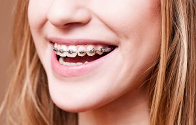 Nahaufnahme einer lächelnden Person mit Zahnspange und hellbraunem Haar.