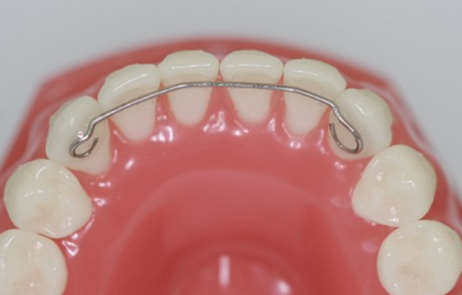 Retainer aus Metall auf der Innenseite der Zähne