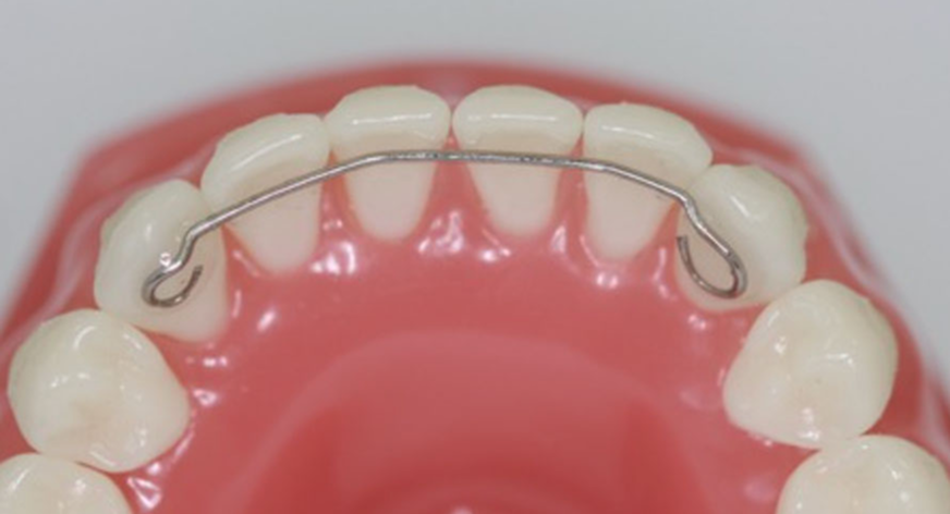 Retainer aus Metall an der Zahninnenseite