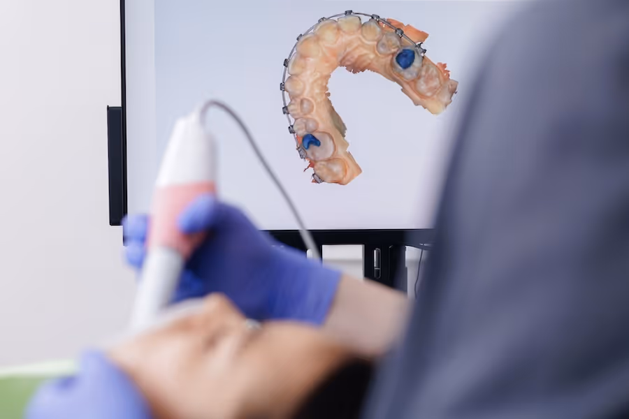 Dental professional holding an intraoral scanner with a digital 3D model of the upper teeth visible on a monitor.