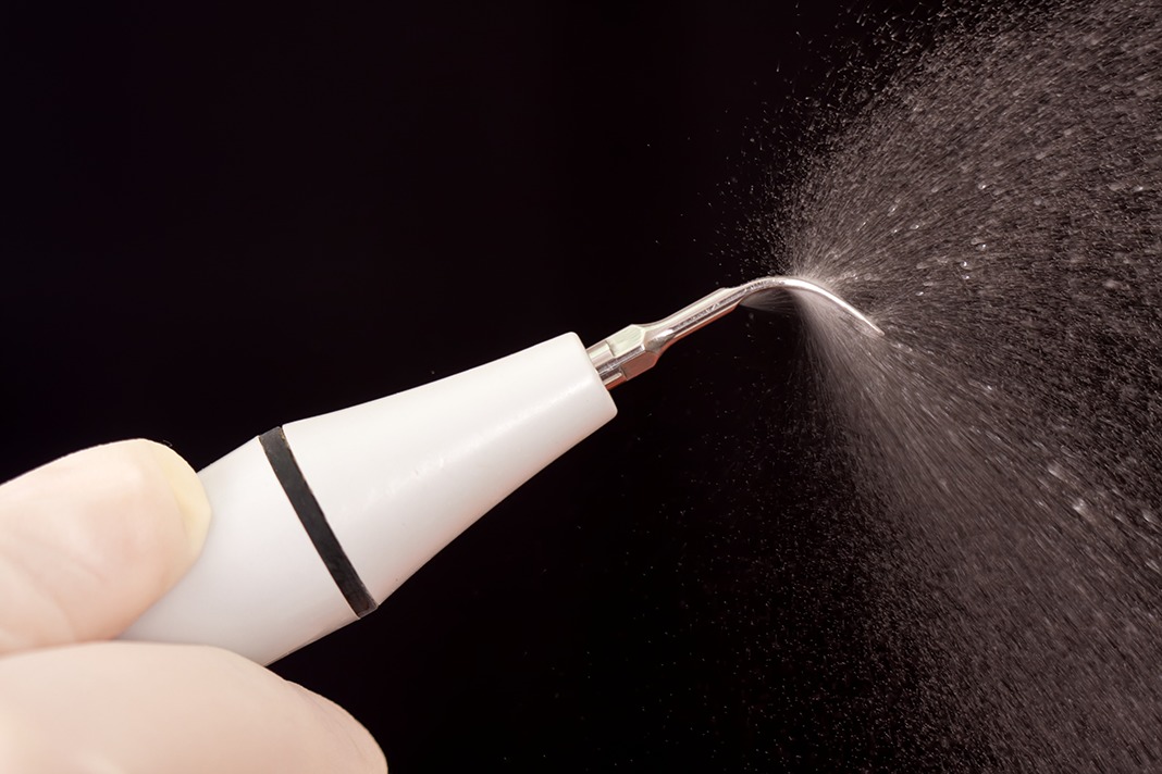 Deep cleaning - calculus removal