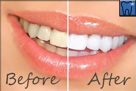 Tooth whitening - In office and at home