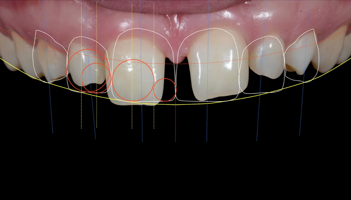 Smile makeover - Cost effective Smile improvement