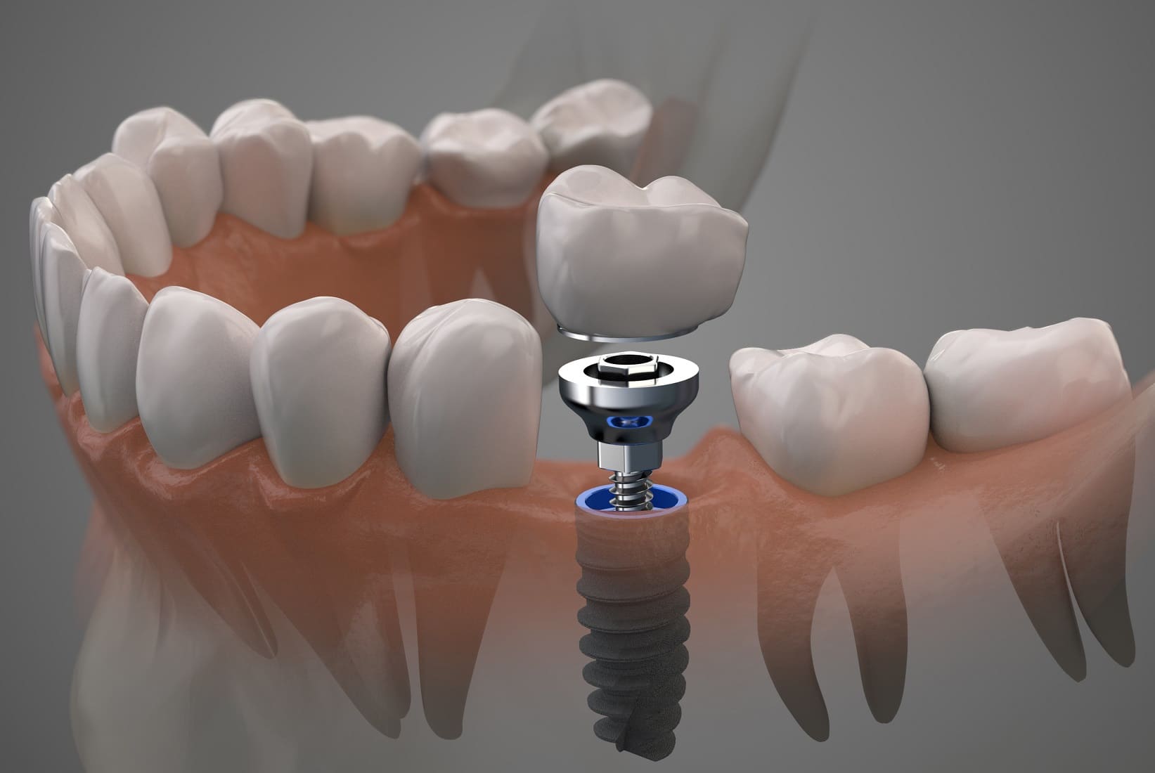 Dental implant - Full mouth rehabilitation