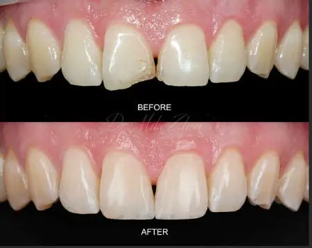 Esztétikus fogtömés