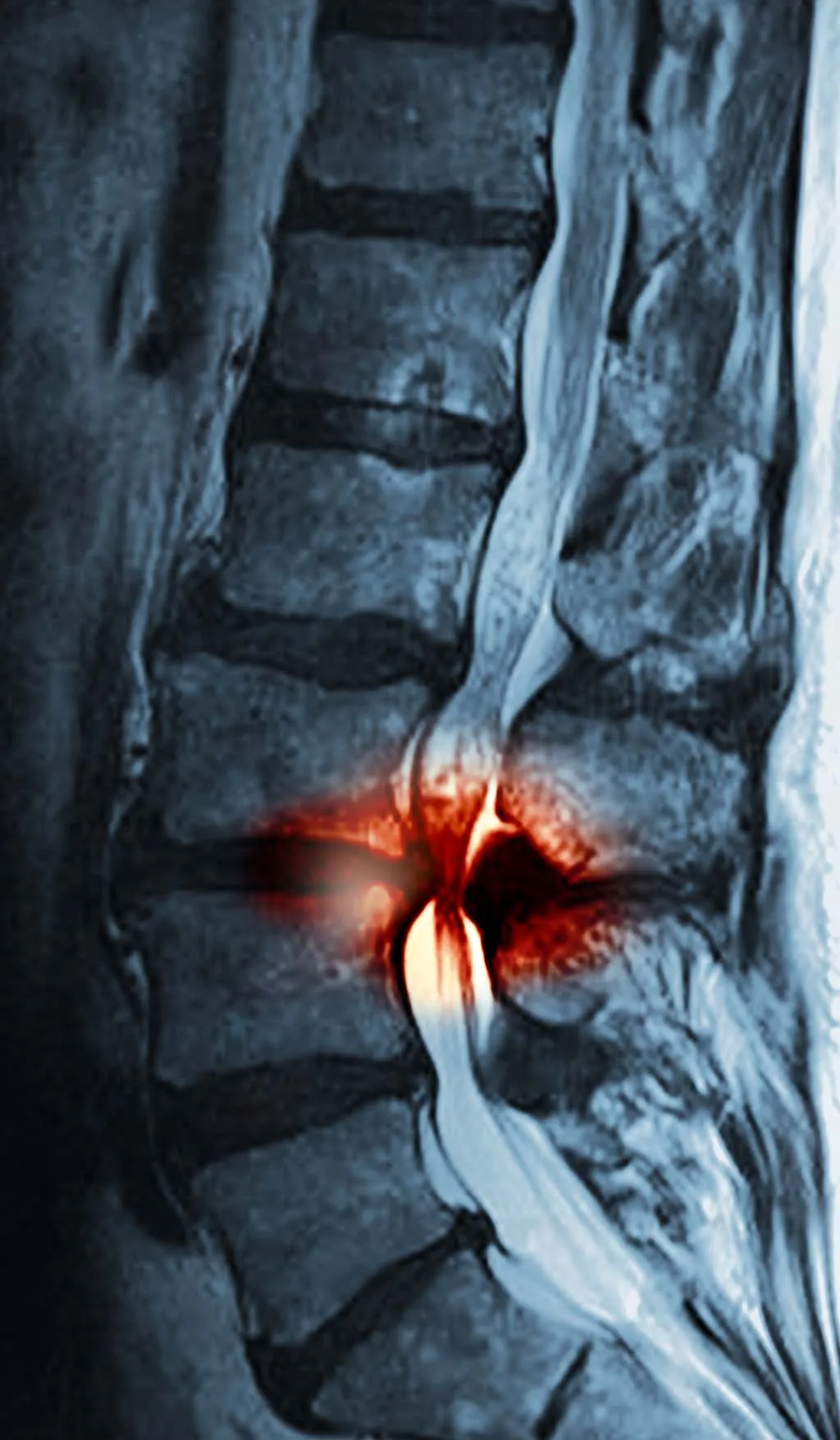 Röntgenaufnahme lumbale Spinalkanalstenose