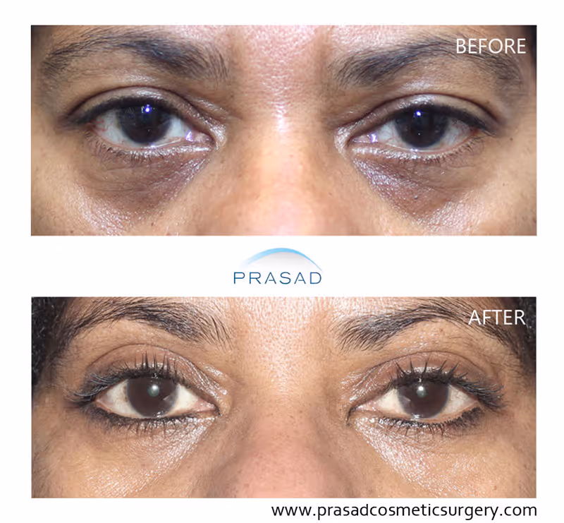 woman in 50s with dark skin showing significantly reduced eye bags