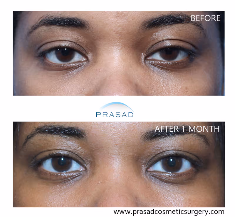 woman of african-american descent showing fast healing and no visible scars or keloid