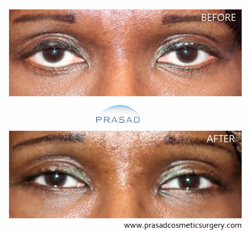 female showing improved lower eyelid after complications