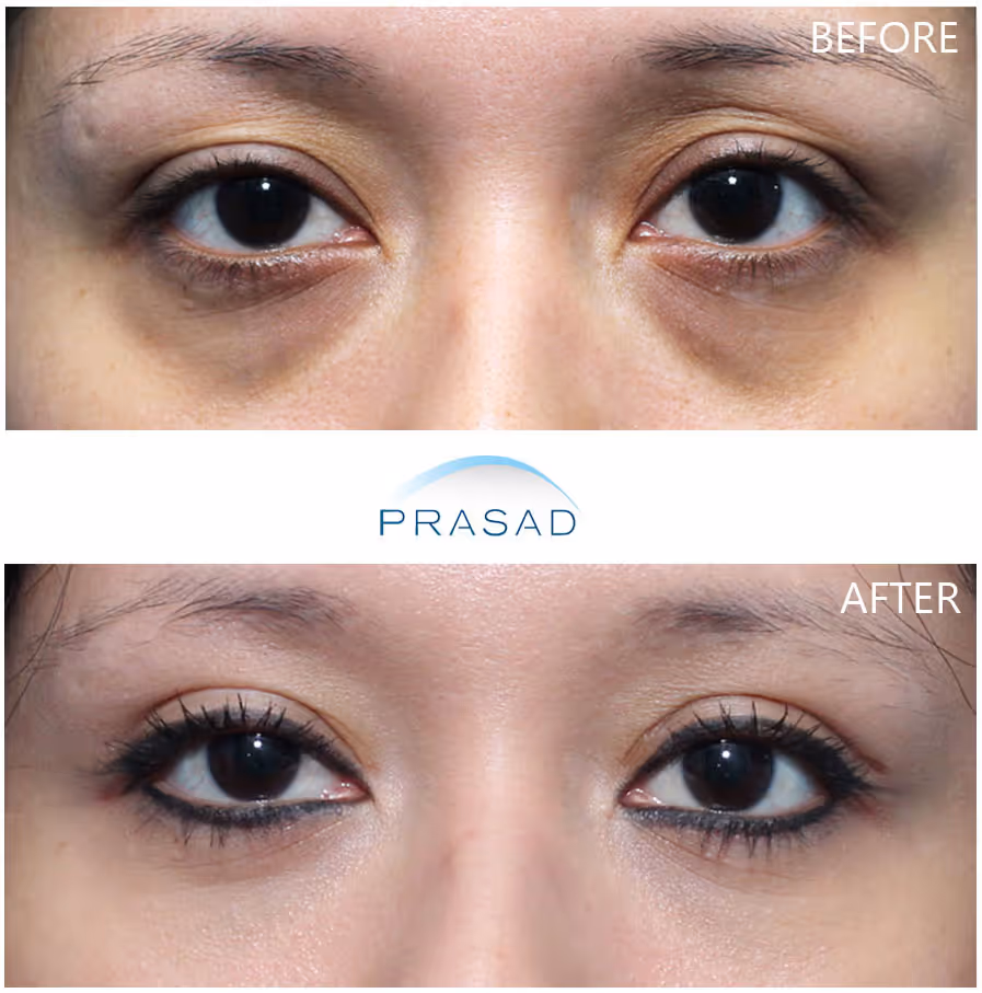 A young woman showing improved under-eye appearance with smoother, brighter under eyes