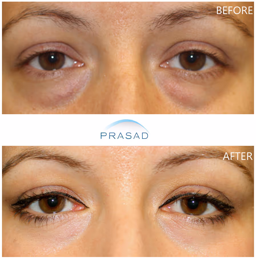Woman in 40s showcasing improved under-eye appearance with no more eye bags