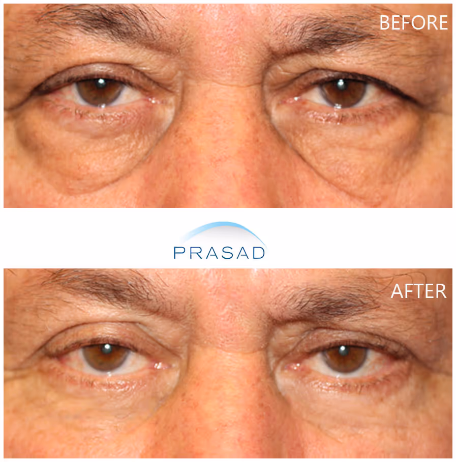 A man in his 60s showcasing significantly brighter and more youthful eyes after reducing eye bags