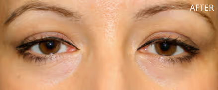 A female with younger looking eyes and fresh look caused by the removal of under eye bags