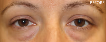 A female with tired looking eyes and obvious under eye bags