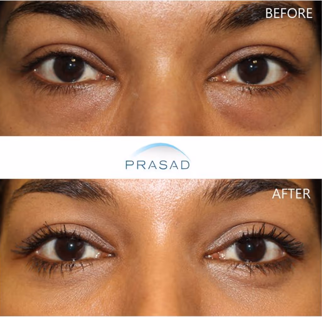 A young woman with bright looking eyes after eyelid procedure