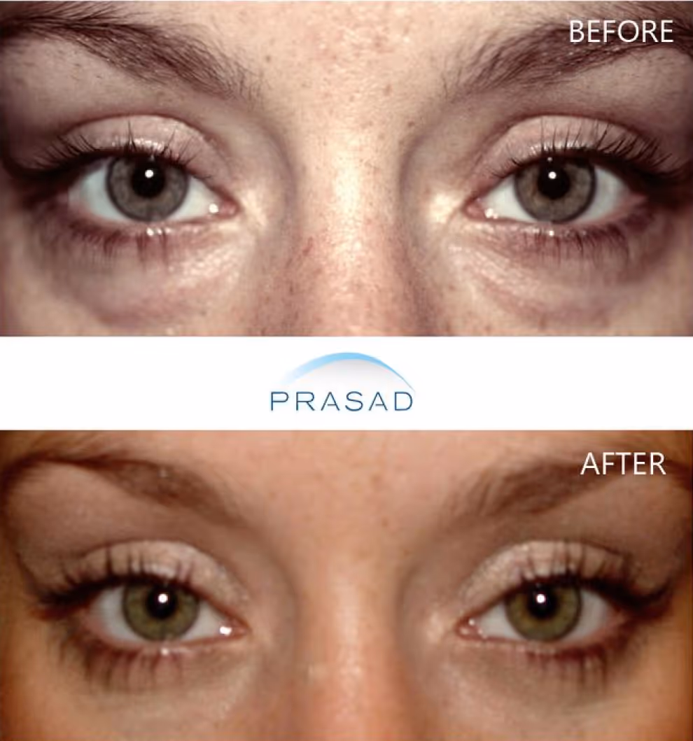 Young female with beautiful and bright looking eyes caused by removal of eye bags
