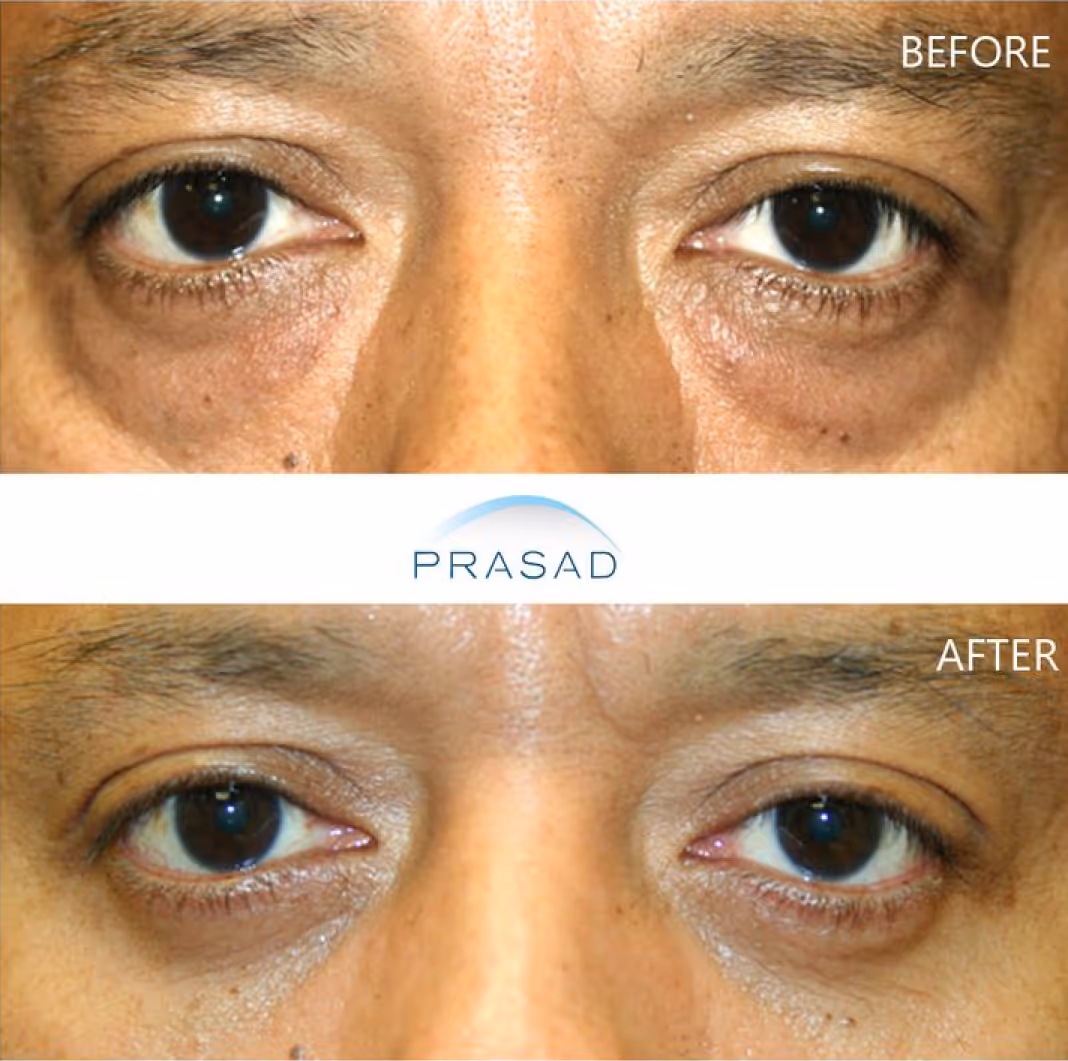 A middle-aged man with dark skin showing no incisions or scars during recovery on his eyelid rejuvenation