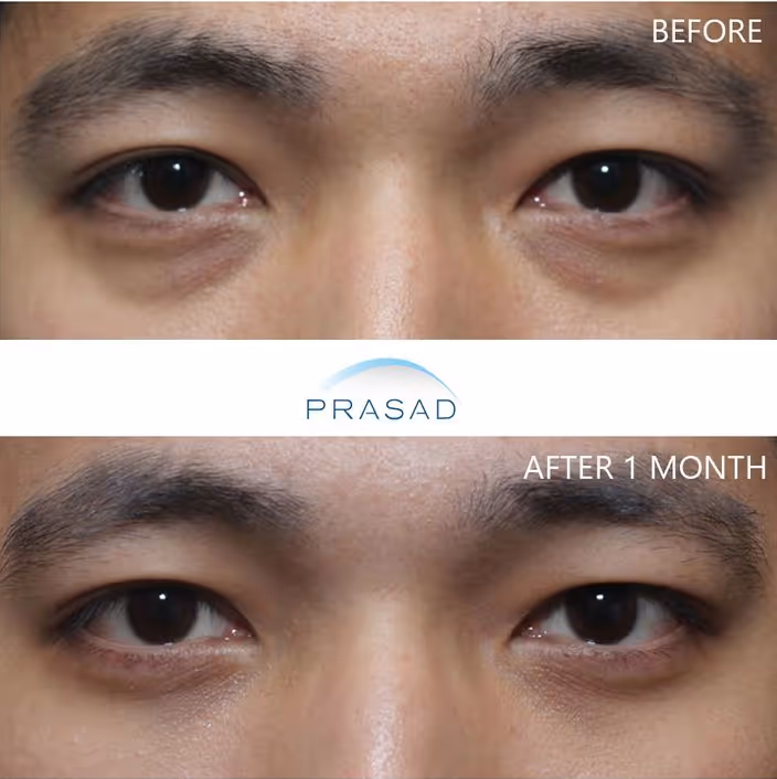 A young male with refreshed and younger looking eyes, free of under-eye bags