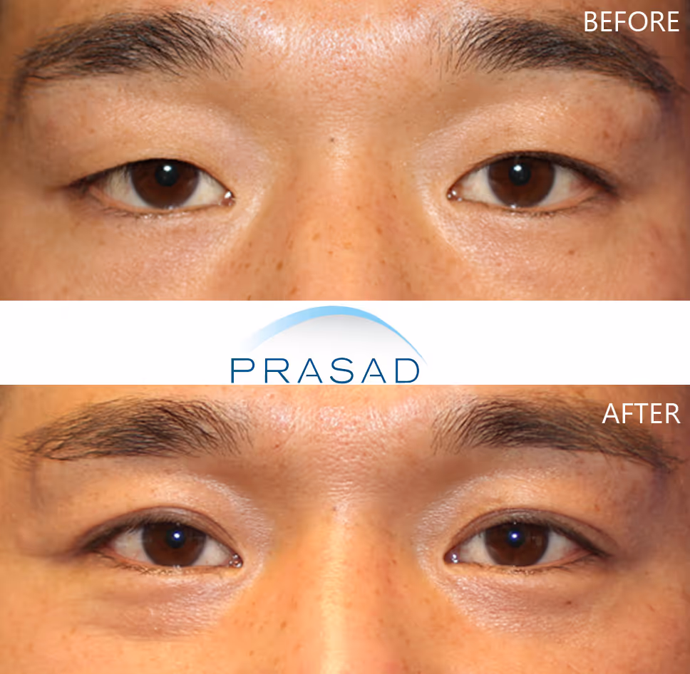 Transformation of a young Asian male with Asian double eyelids