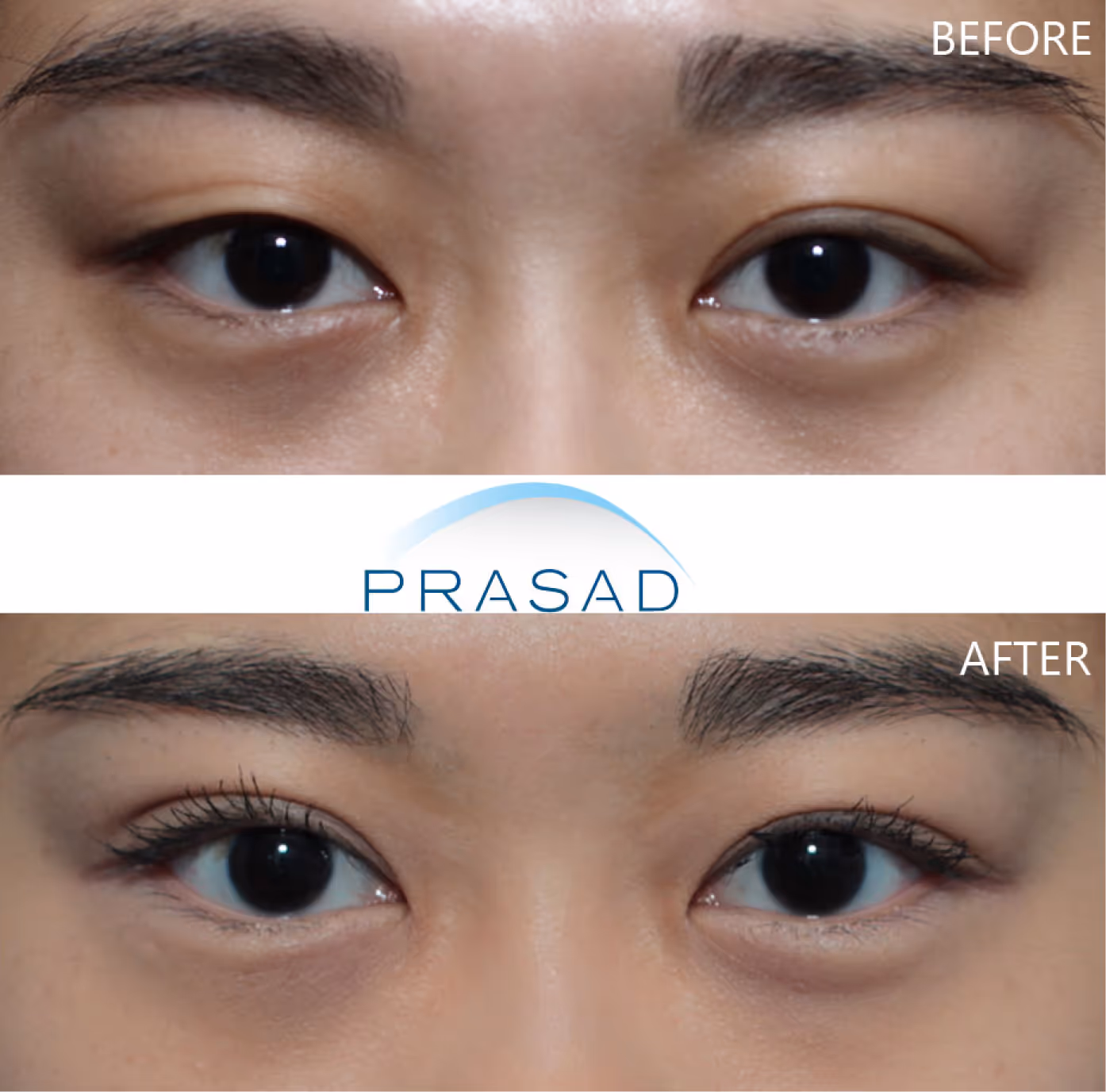 Eyelid transformation of a young female having multiple creases