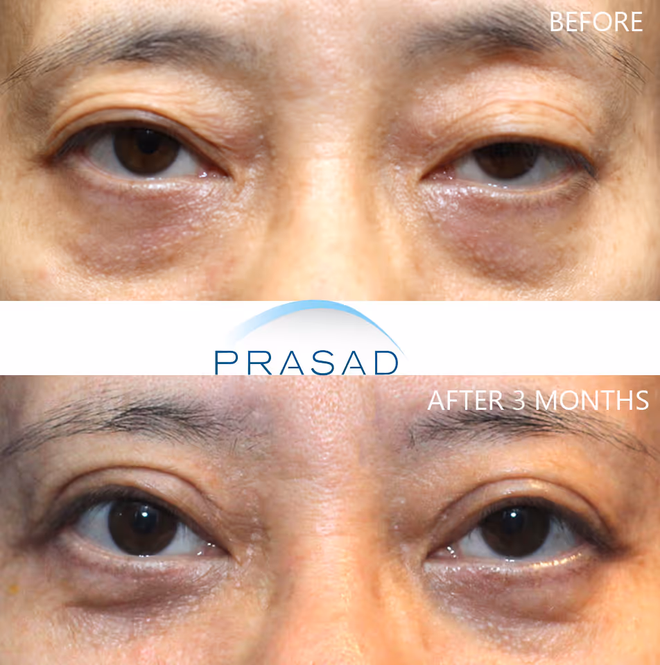 Enhance eye appearance of Asian female having drooping eyelids