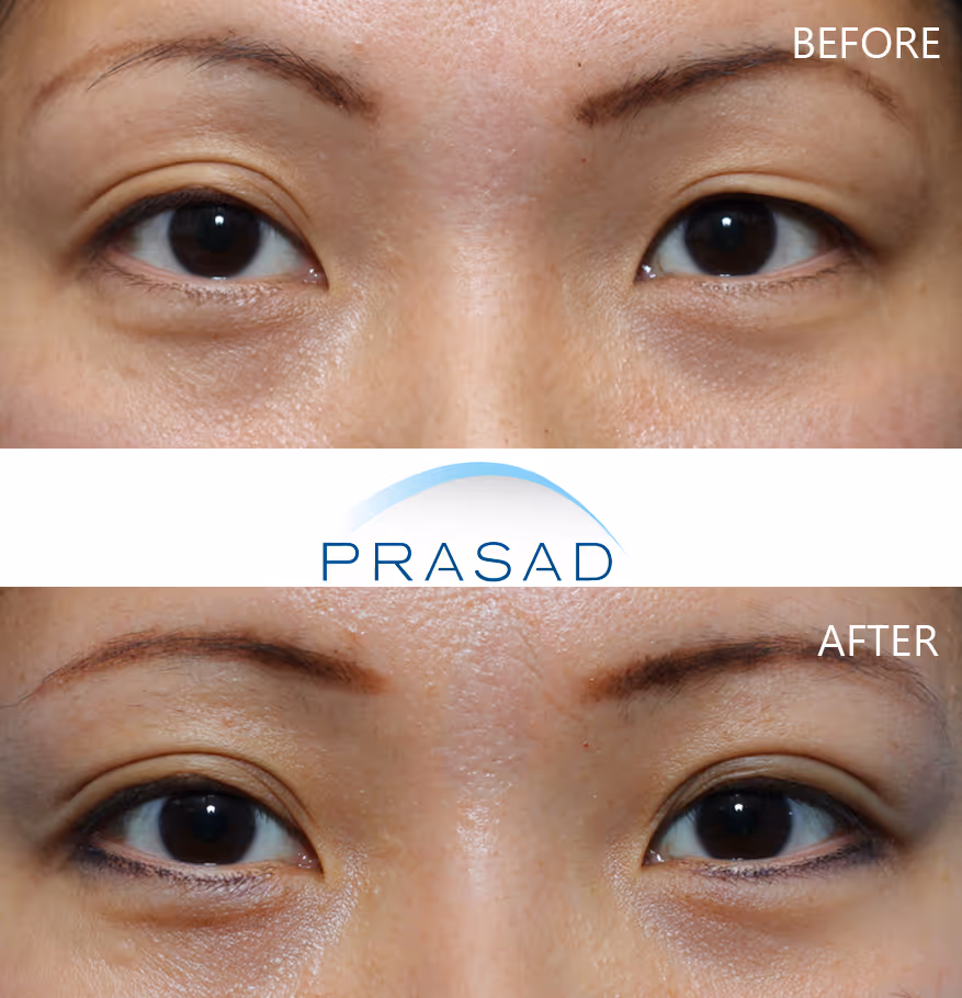 Eyelid refinement of Asian female seeking revision from previous experience