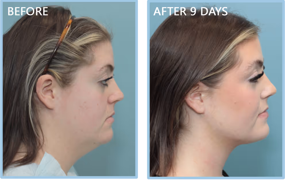 A woman with a dramatic transformation in her neck and jawline.