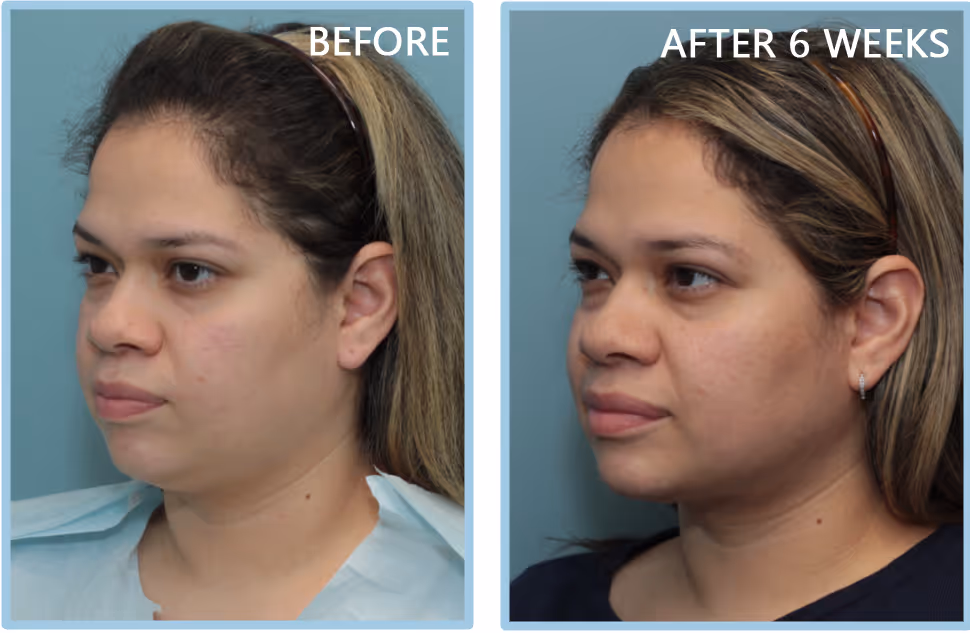 Female patient looking youthful after the removal of a double chin and sagging neck.