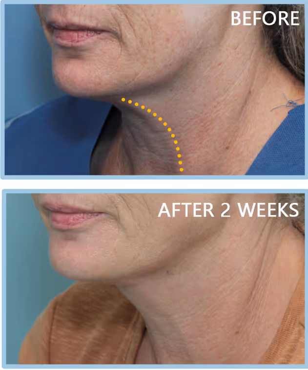 Female in her 50s looking more youthful with neck contourplasty