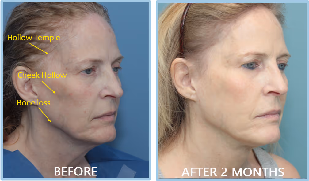 Female in her 60s looking more youthful, with volume enhancement and a neck lift