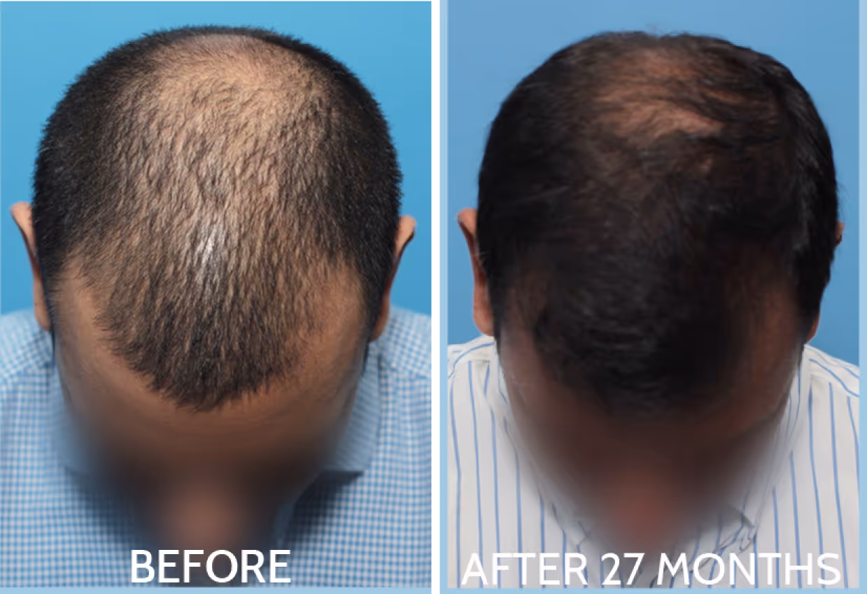 Top view of a man's head showing noticeable hair thinning and hair growth