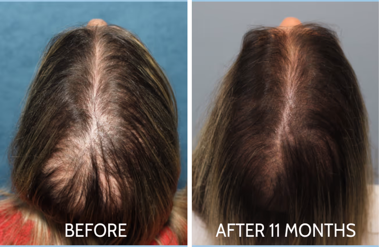 Top view of a woman's head showing noticeable hair growth from androgenetic alopecia
