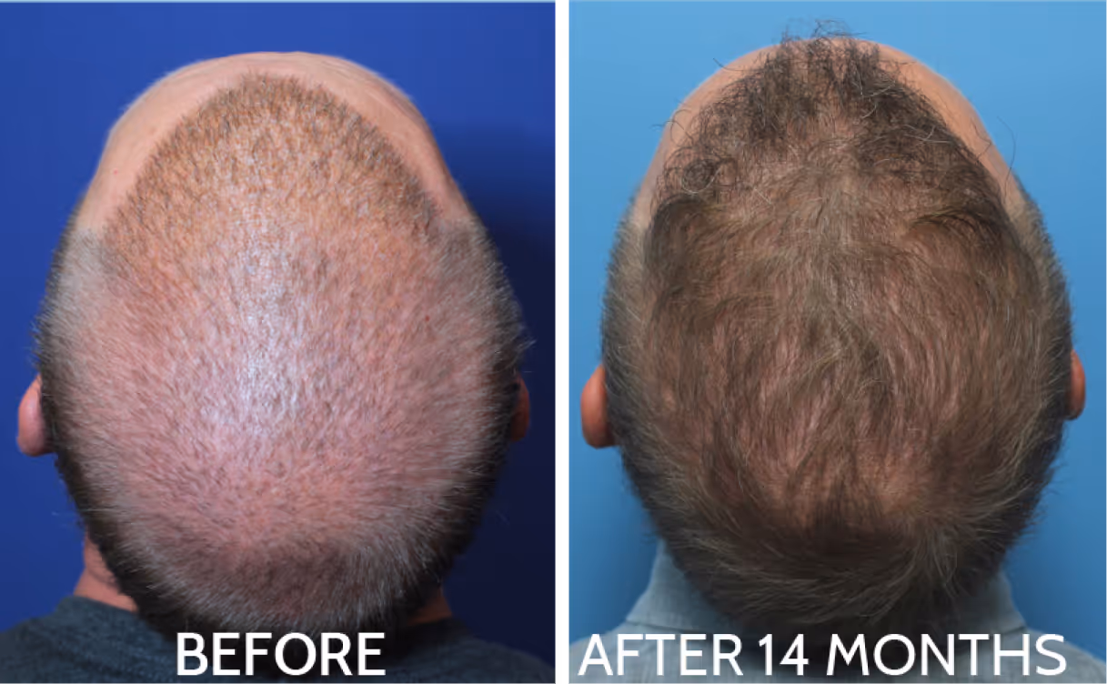Top view of a man's head showing noticeable hair growth from hair transplant