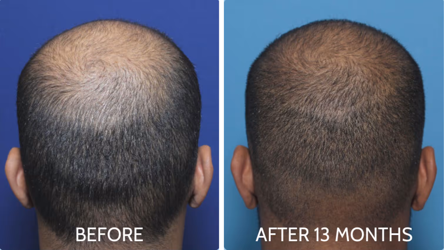Back view of a man's head showing noticeable hair restoration from advance hair loss