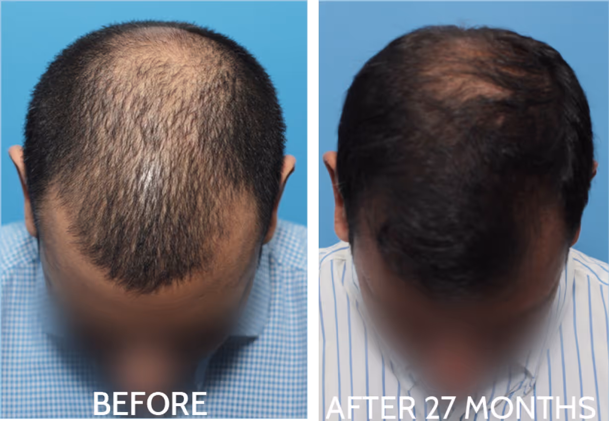 Top view of a man's head showing noticeable hair regrowth from male pattern baldness.