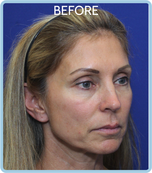 A female with tired looking eyes and obvious under eye bags