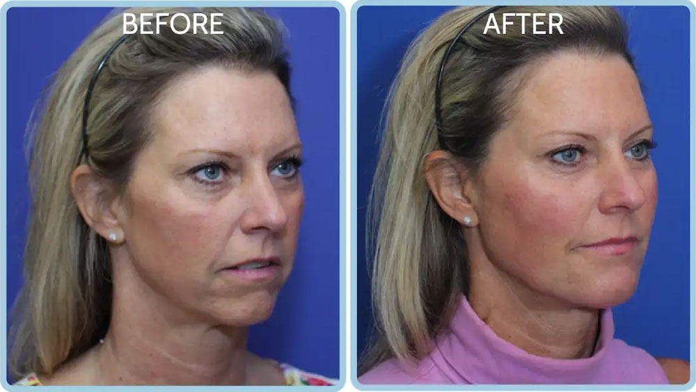 Nonsurgical facelift for over 50s looking rejuvenated, with defined jawline and cheeks