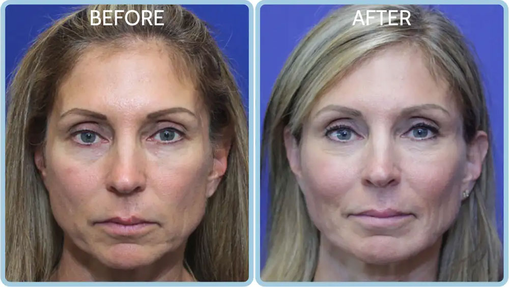 Female in her 40s looking more youthful, with defined jawline and chin
