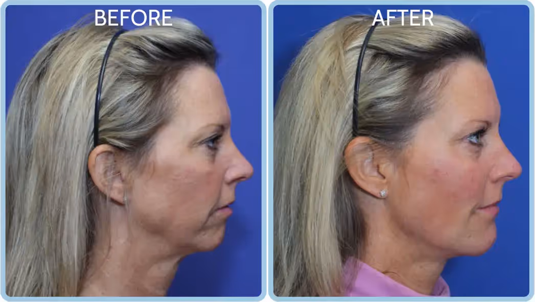 Female in her 50s looking rejuvenated, with tightened skin and a more sculpted appearance