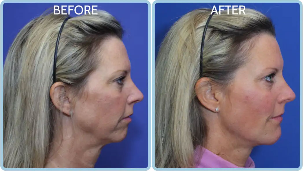 Female in her 50s looking rejuvenated, with tightened skin and a more sculpted appearance